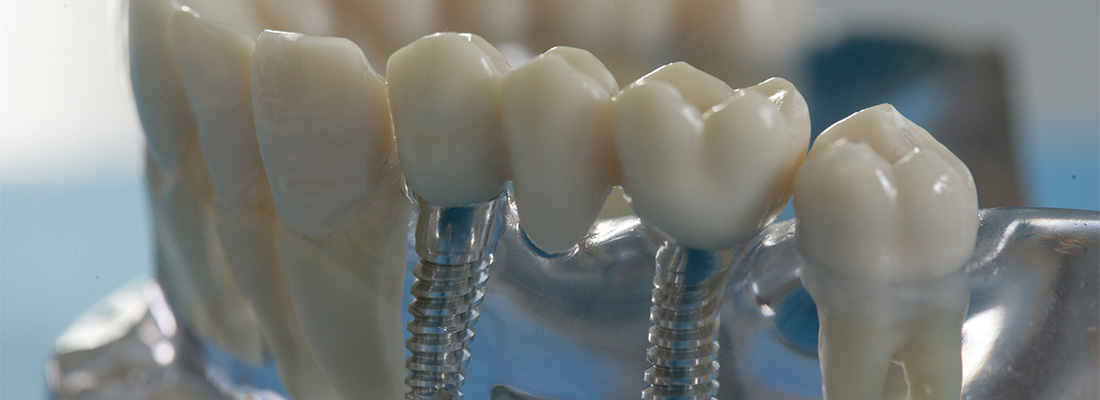 Feste Zähne mit Zahnimplantaten in Schönebeck
